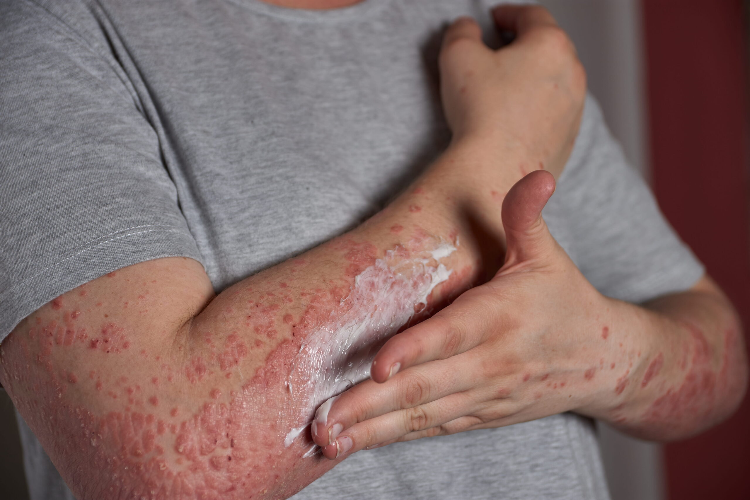 Psoriasis & Eczema Care